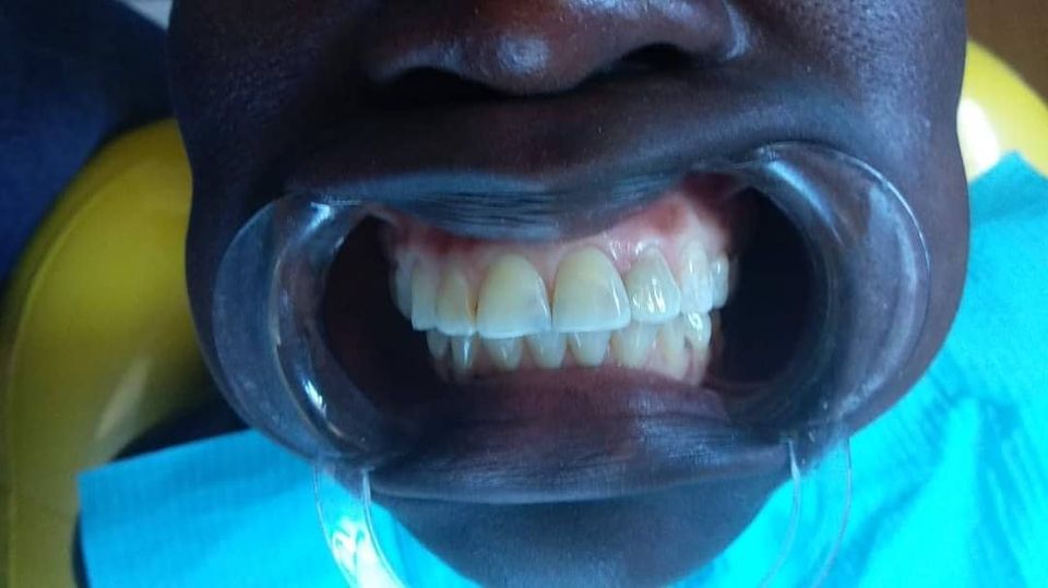 Teeth Filling