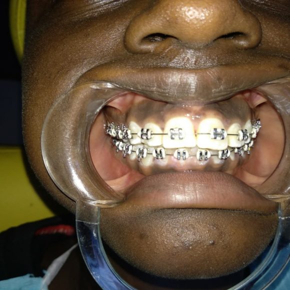 Braces; Teeth Alignment