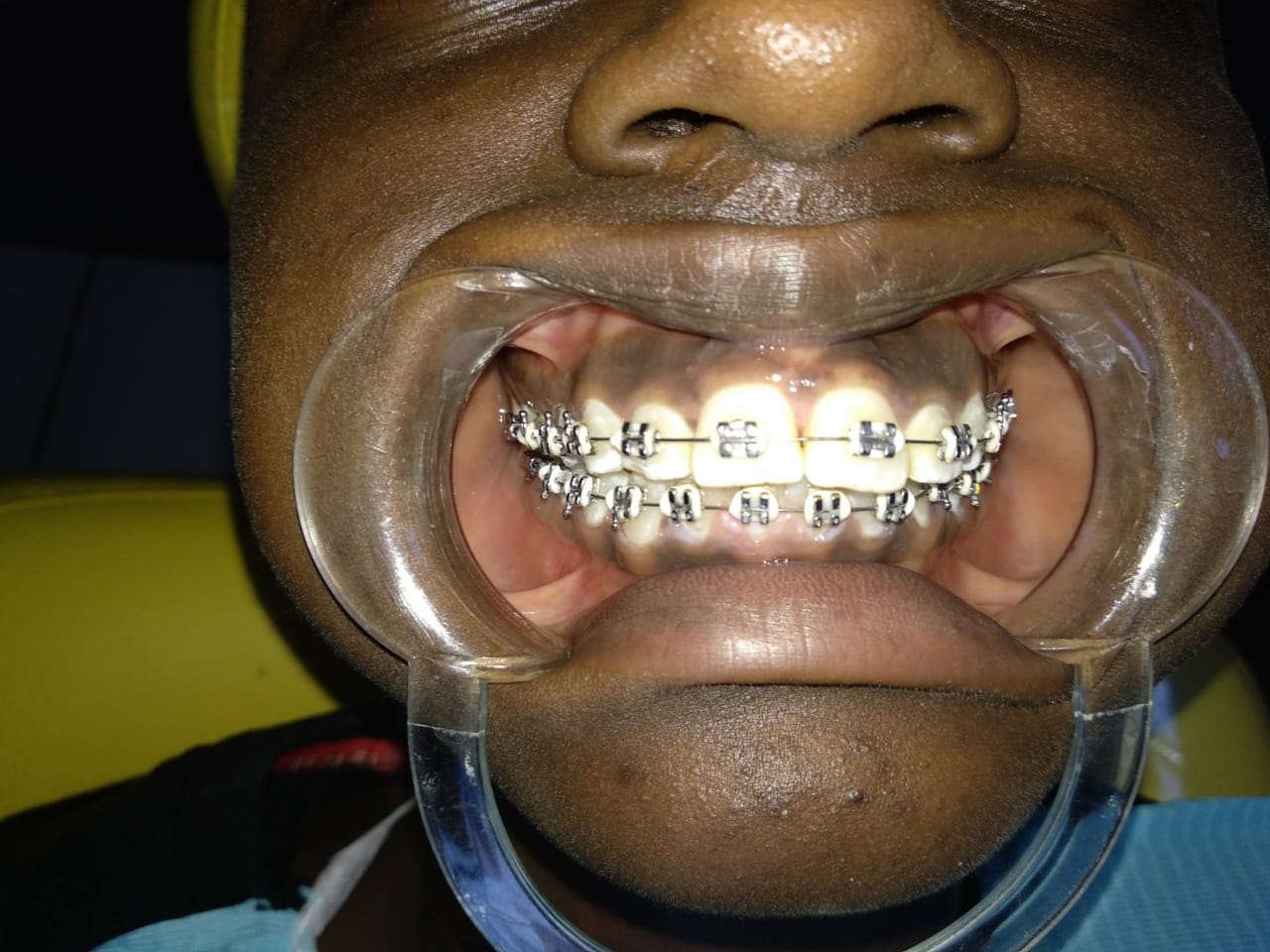 Braces; Teeth Alignment