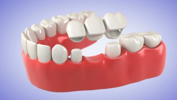 Crowns, Dentures, Implants- Teeth Replacement - Nairobi | Kisumu