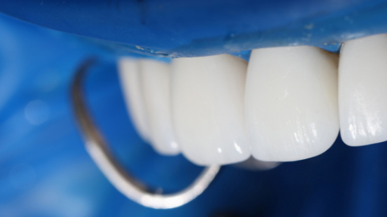 Dental crowns in Kenya; restore, enhance and protect your smile