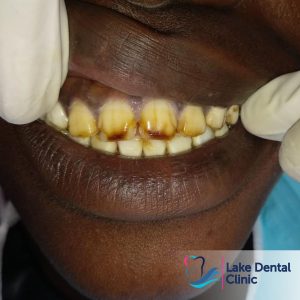 Dental fluorosis