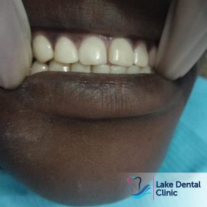 Dental fluorosis treatment - dental masking