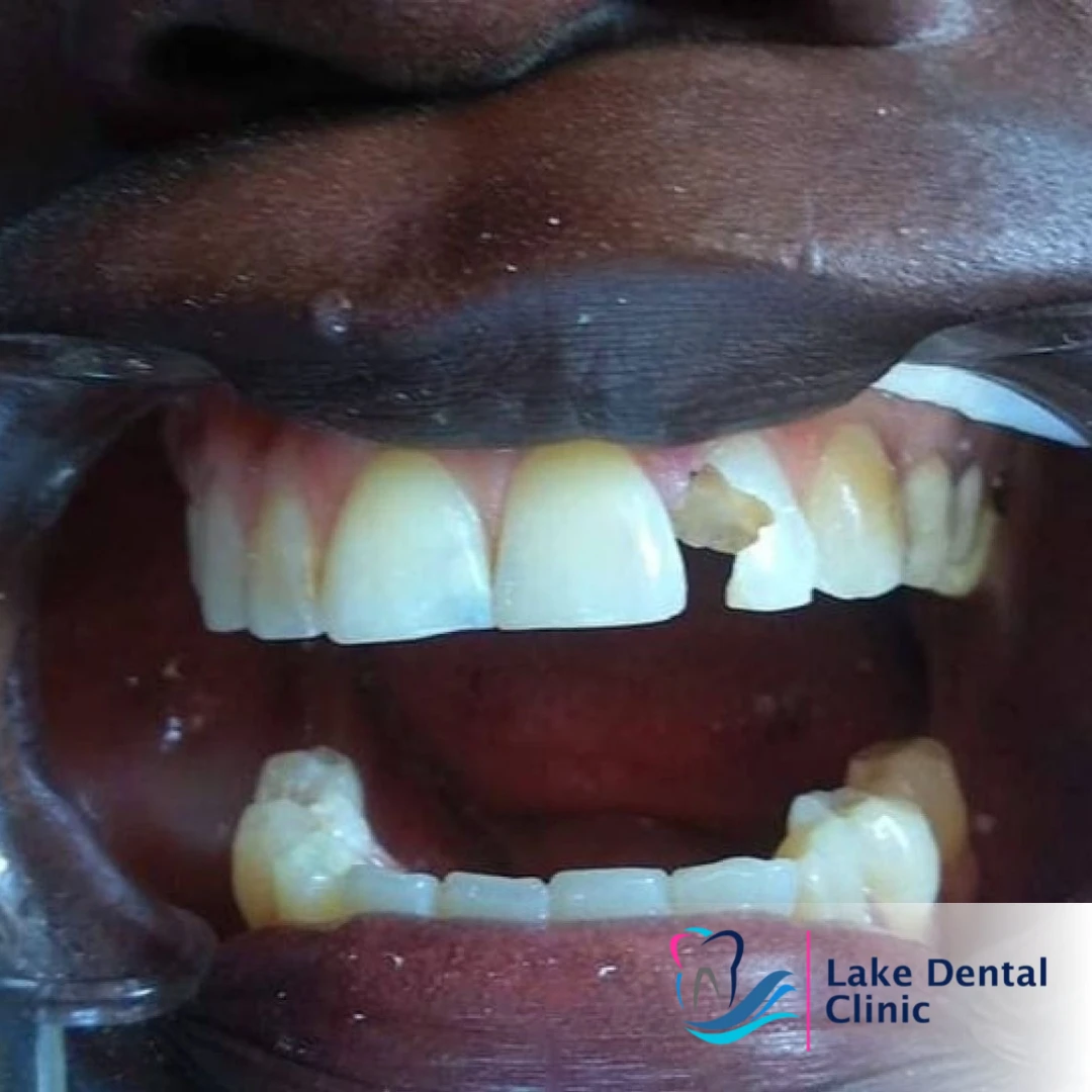 dental fillings for cavities in Kenya
