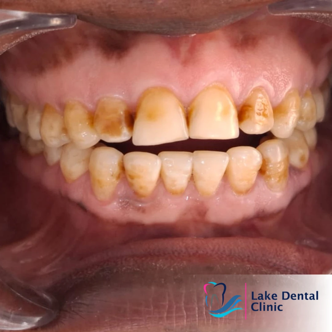 Dental masking treatment for dental fluorosis teeth whitening