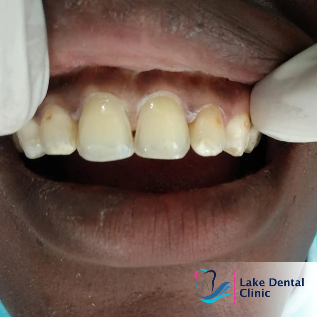 Dental masking treatment for dental fluorosis teeth whitening