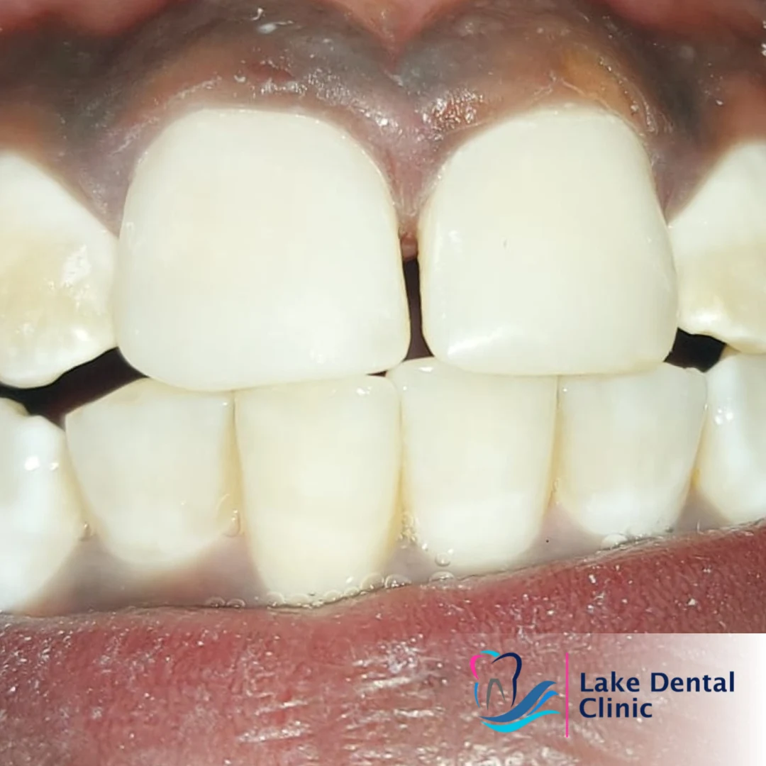 Dental masking treatment for dental fluorosis teeth whitening