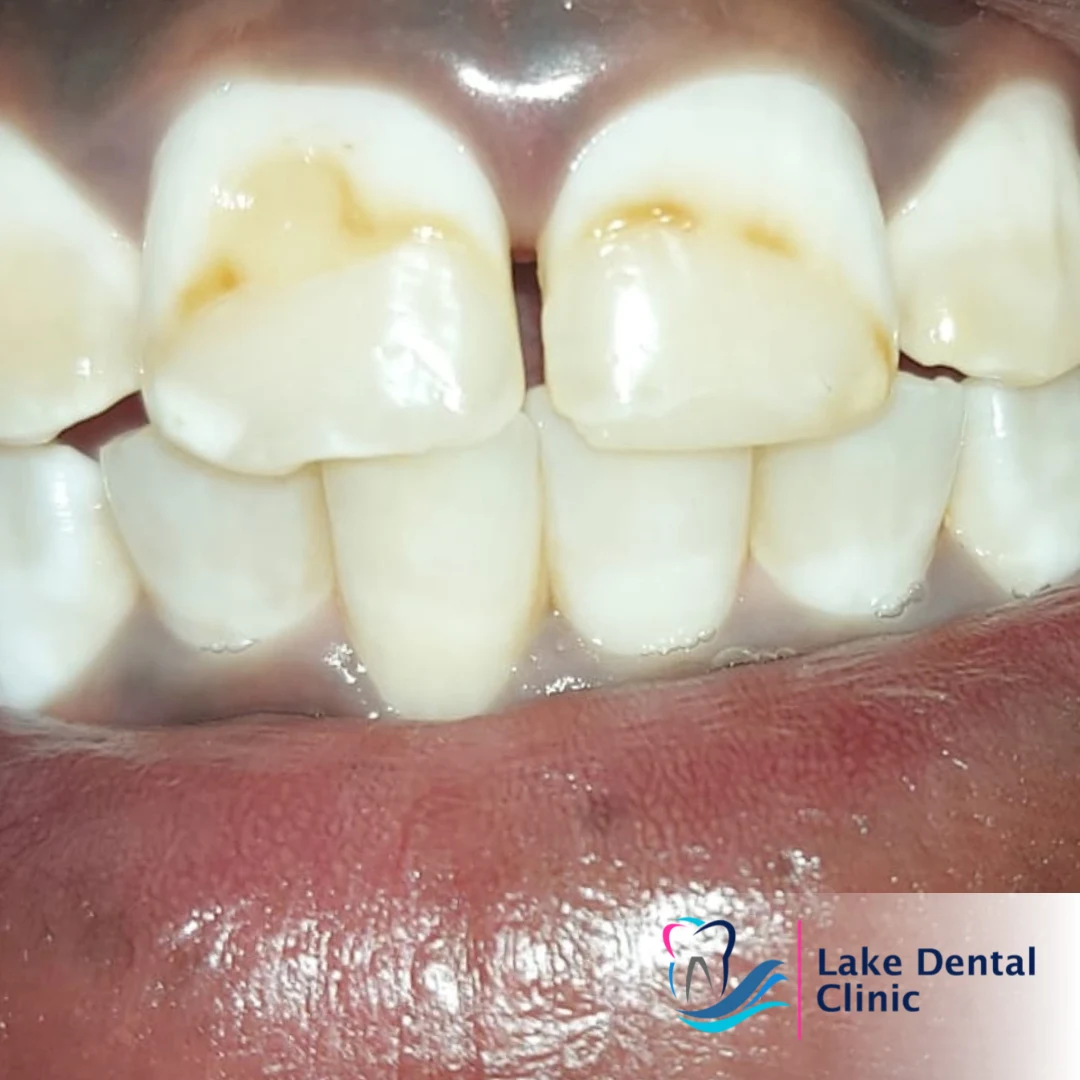 Dental masking treatment for dental fluorosis teeth whitening