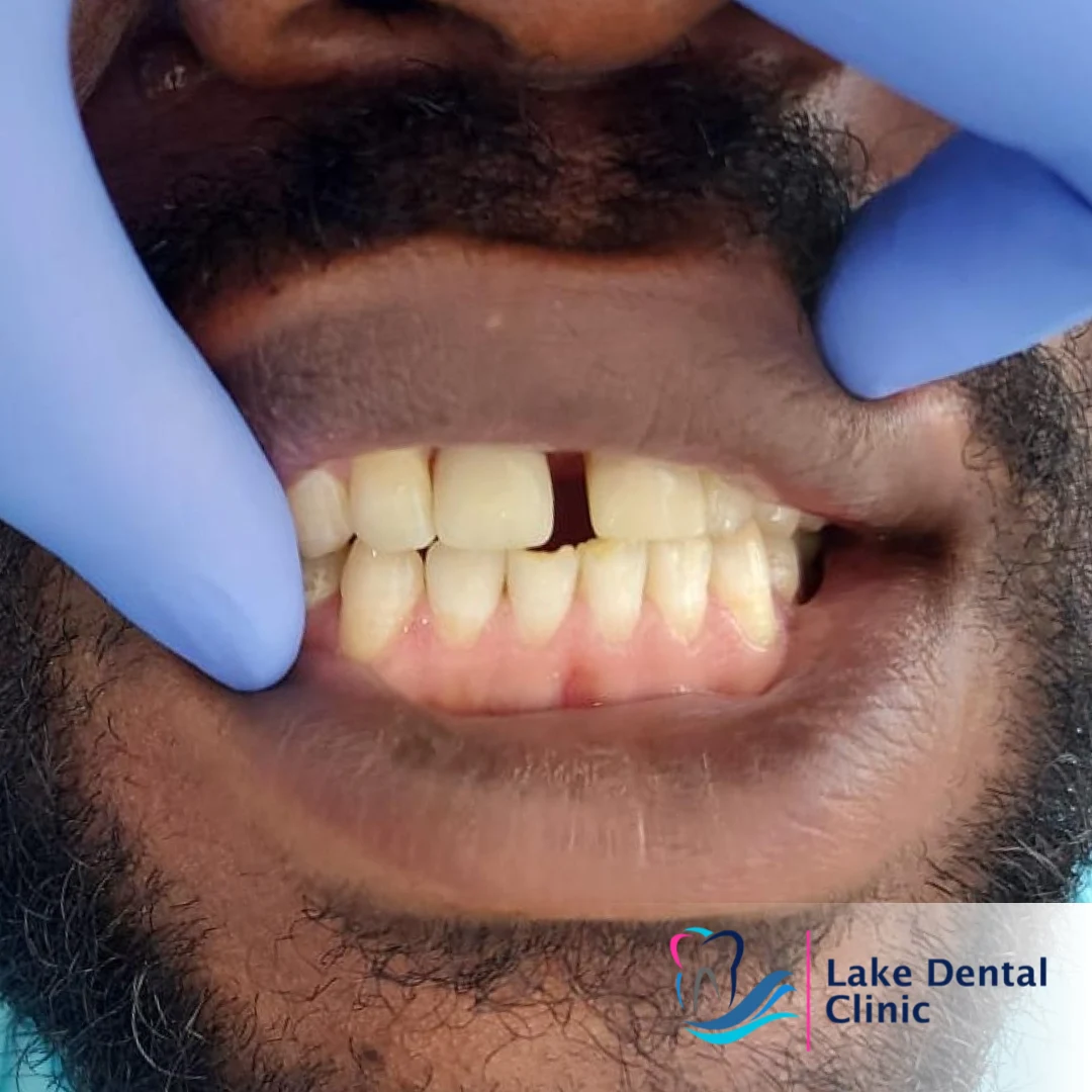 dentures, bridges and implants teeth replacement for missing teeth