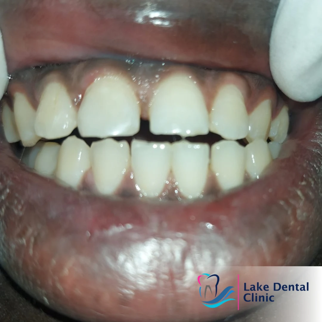 tooth dental filling for chipped fractured teeth in kenya