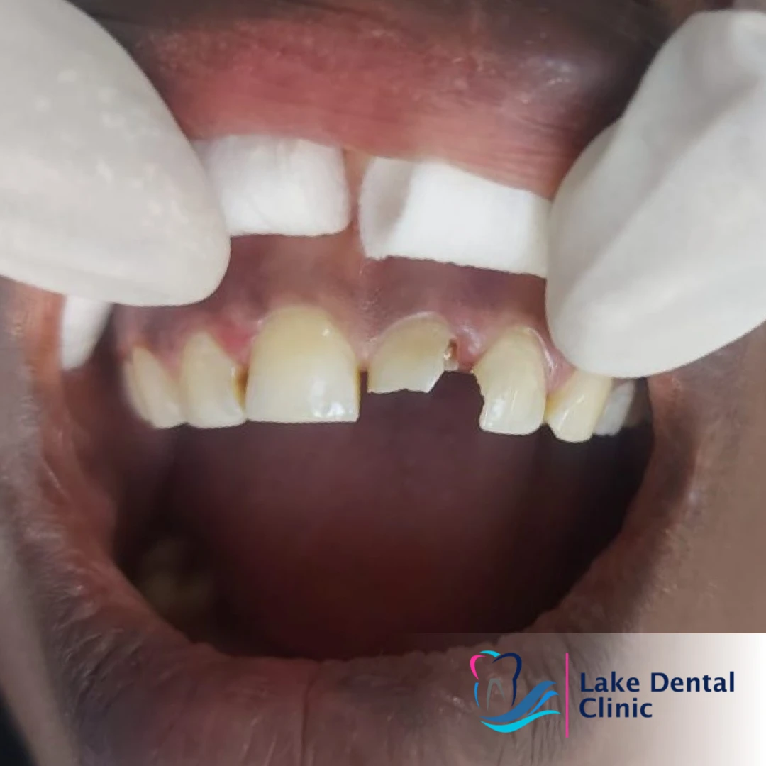 tooth dental filling for damaged fractured teeth in kenya