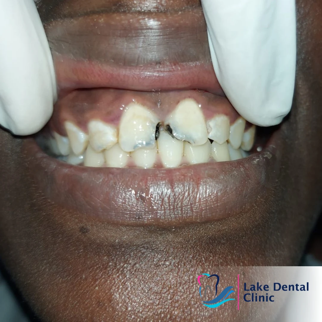 tooth dental filling for decayed fractured teeth in kenya