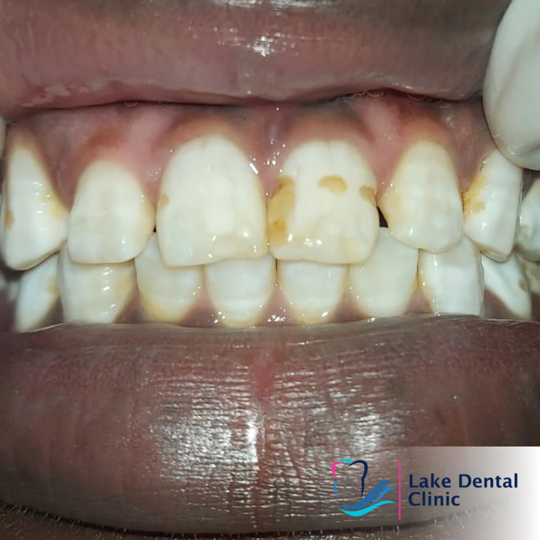 Dental masking treatment for dental fluorosis teeth whitening