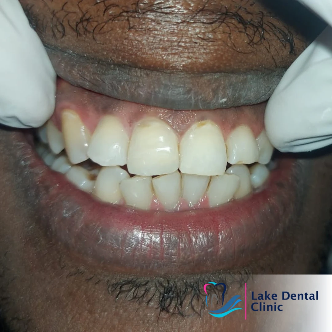 tooth dental filling for chipped fractured teeth in kenya