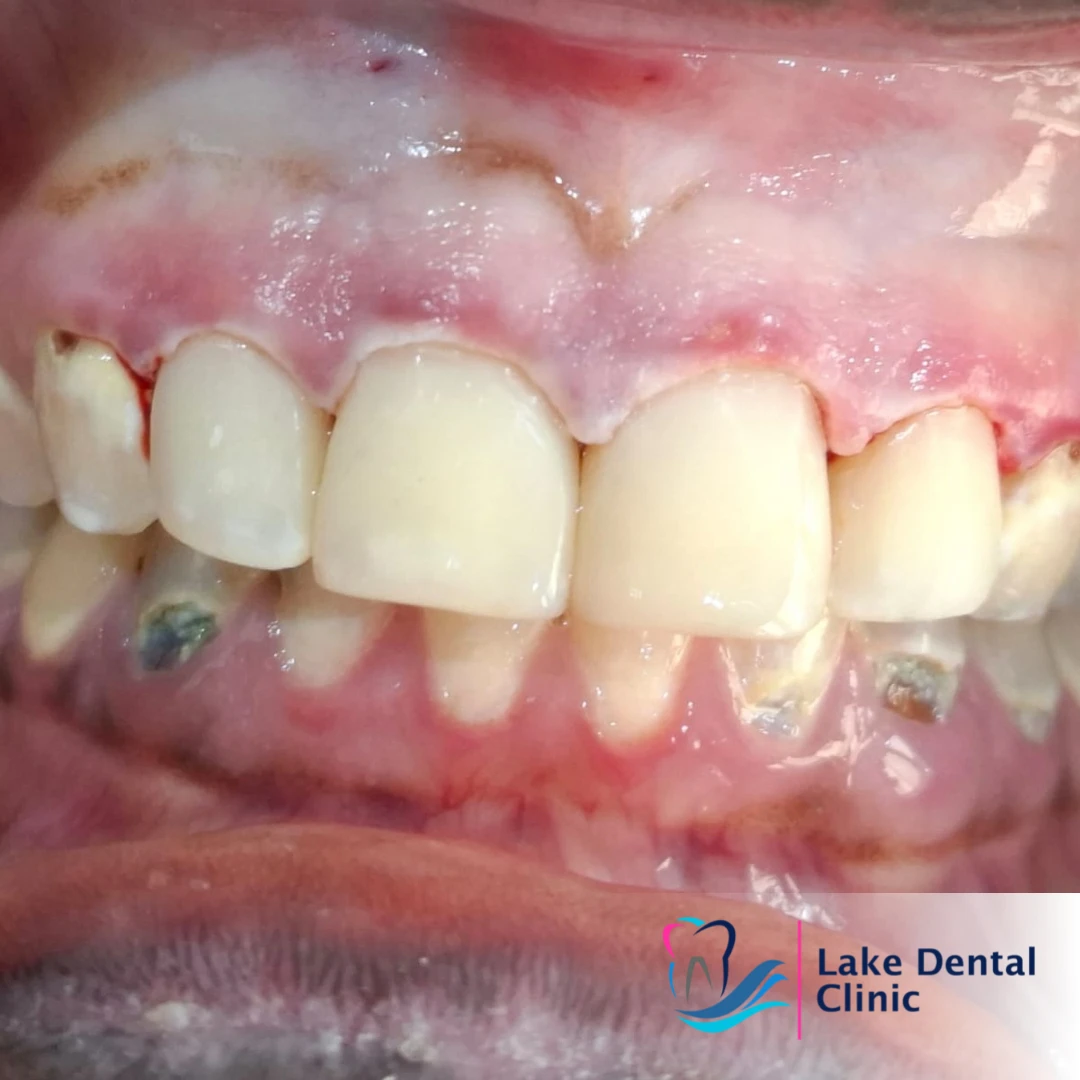 dental caries treatment