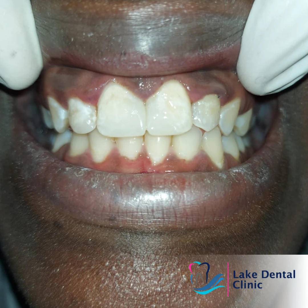 tooth dental filling for decayed fractured teeth in kenya