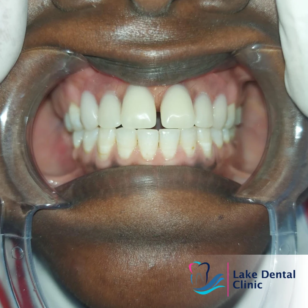 dentures, bridges and implants teeth replacement for missing teeth