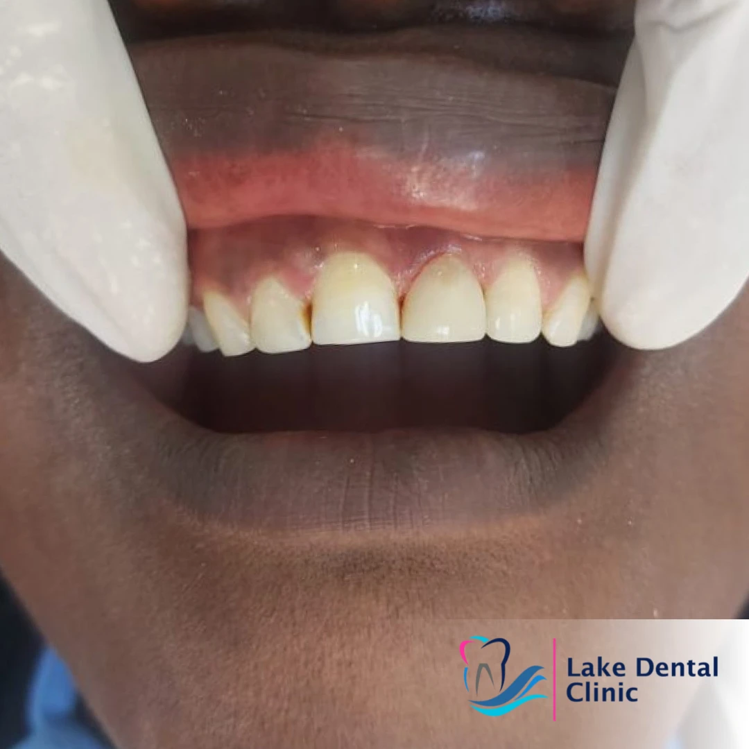 tooth dental filling for damaged fractured teeth in kenya