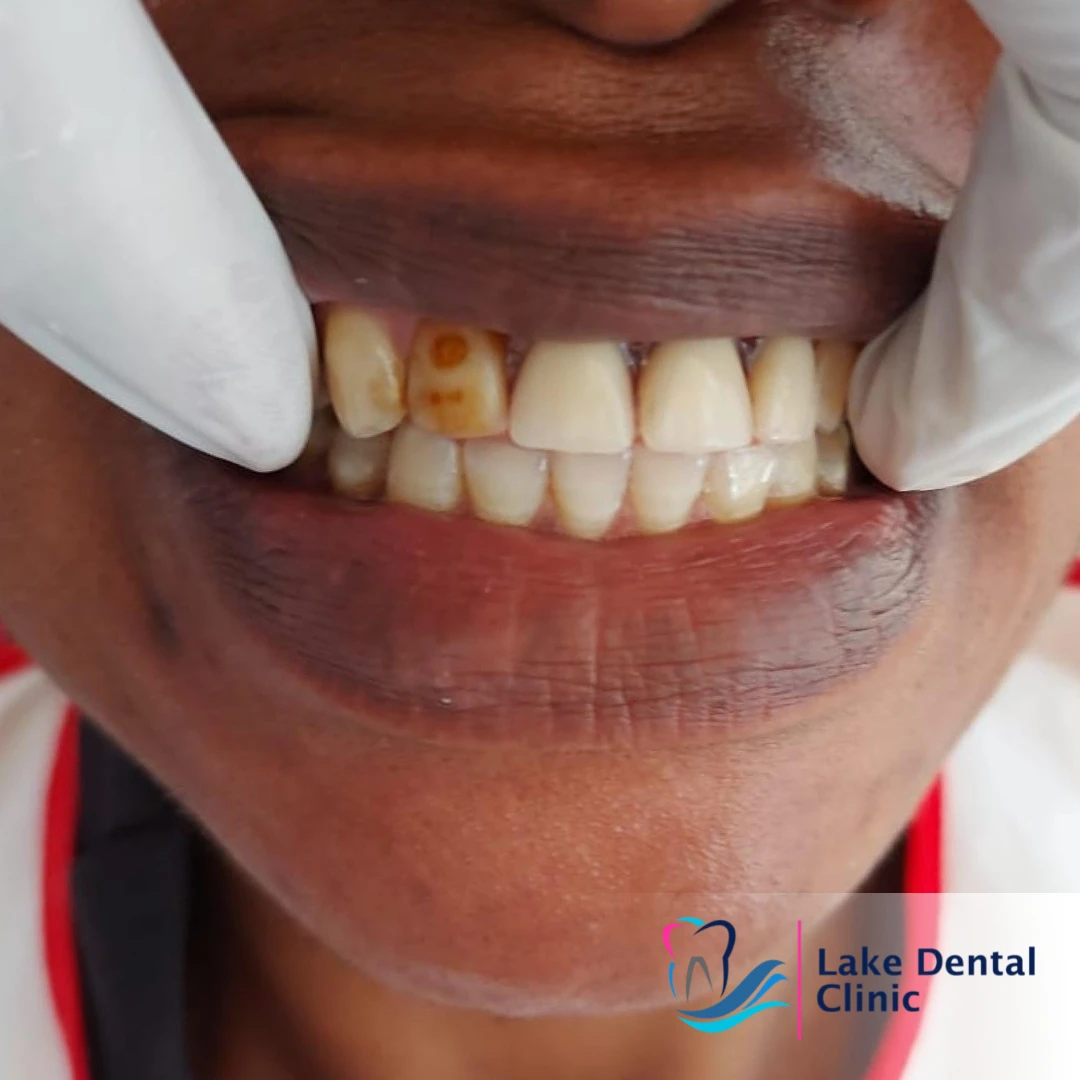 dentures, bridges and implants teeth replacement for missing teeth