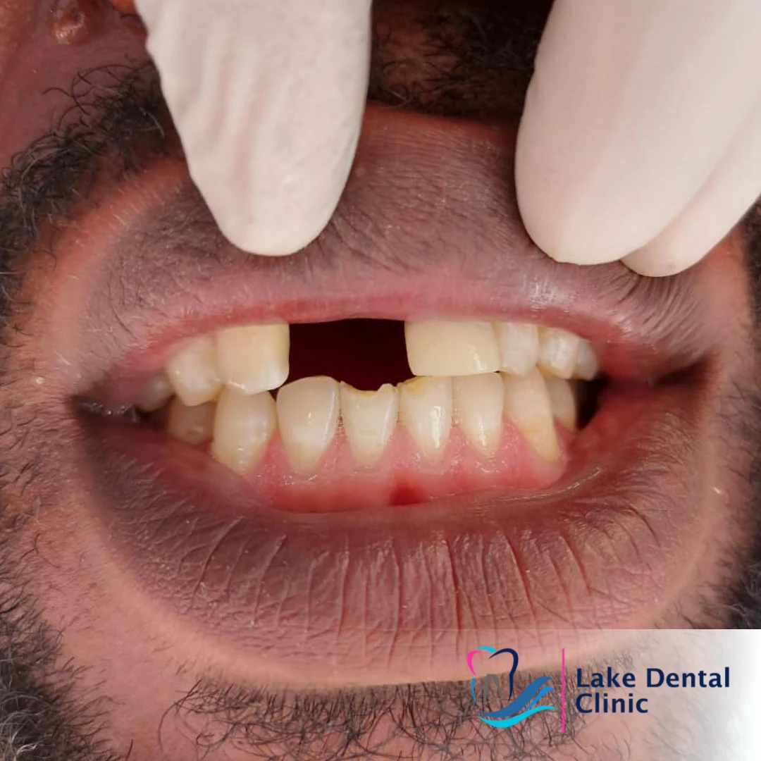 dentures, bridges and implants teeth replacement for missing teeth