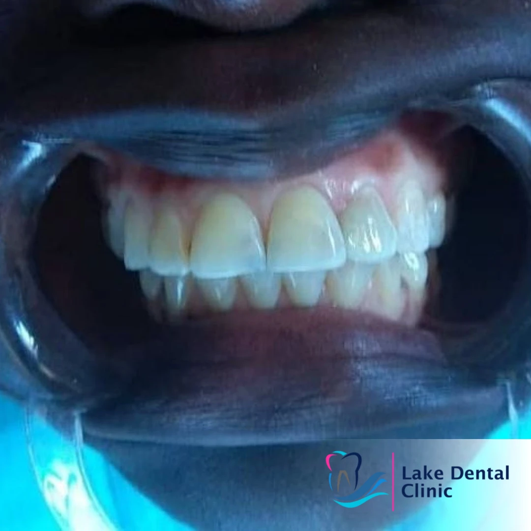 dental fillings for cavities in Kenya