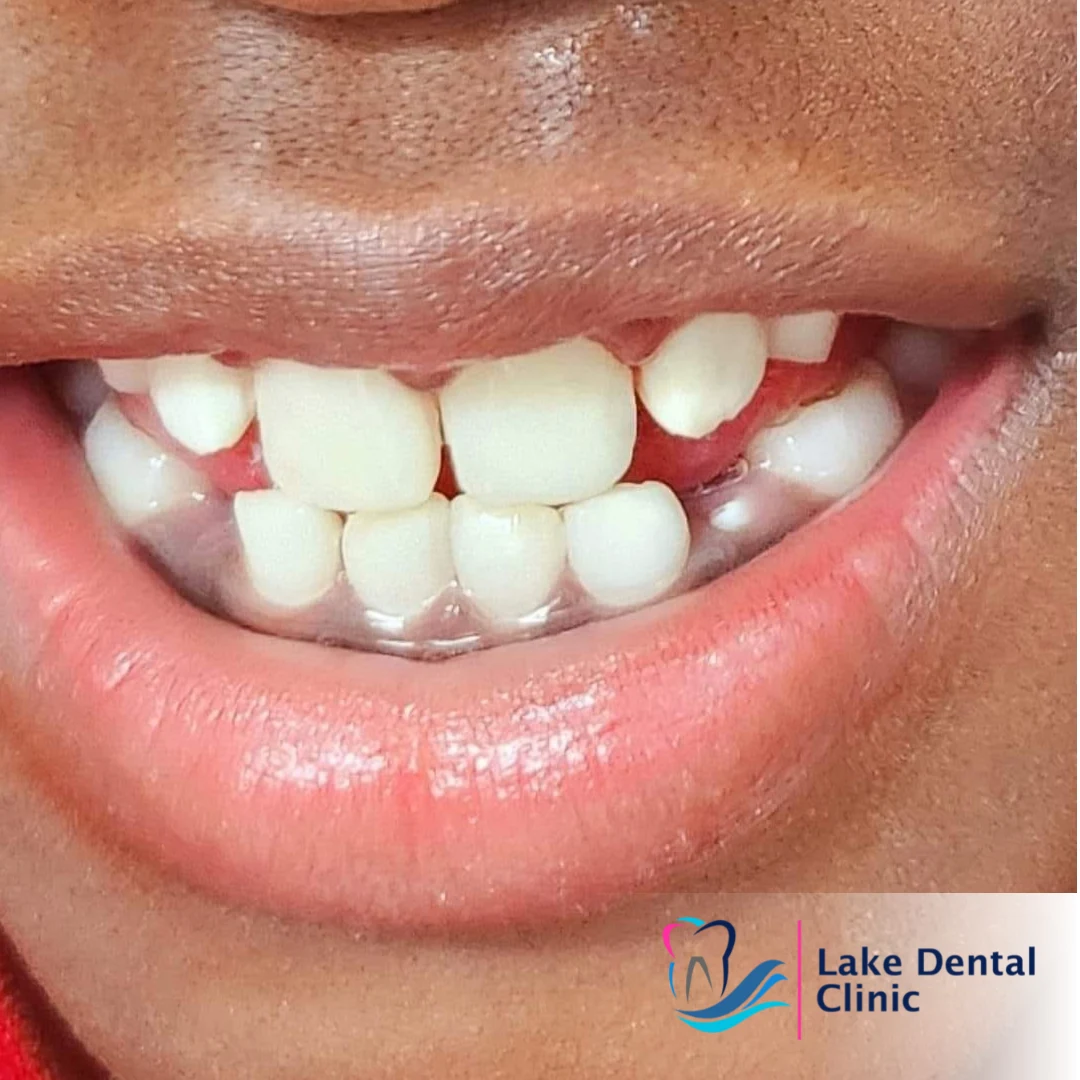 Dental masking treatment for dental fluorosis teeth whitening