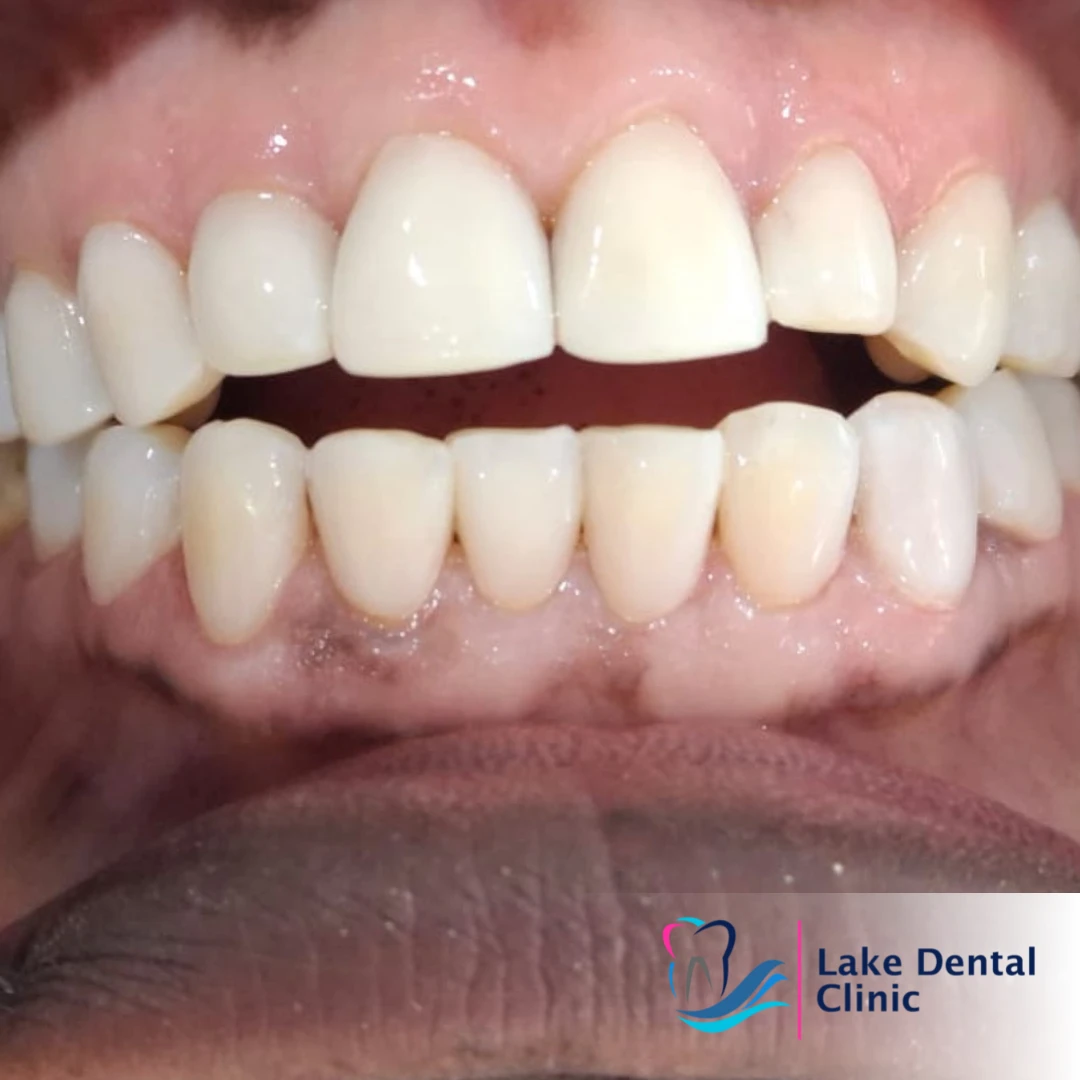 Dental masking treatment for dental fluorosis teeth whitening