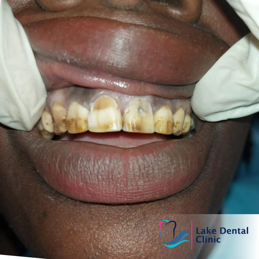 Dental masking treatment for dental fluorosis teeth whitening