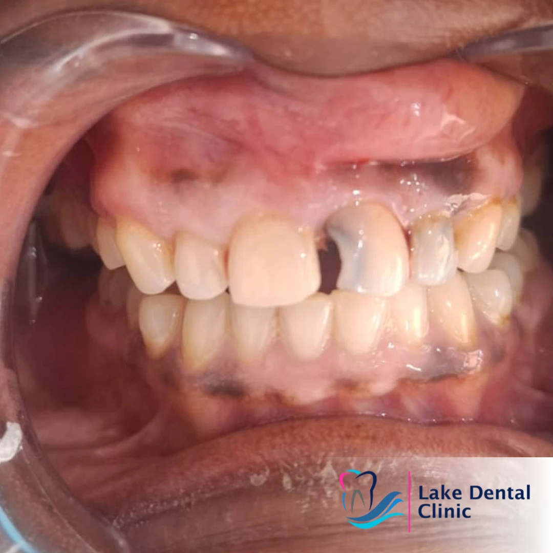 treatment for cavities