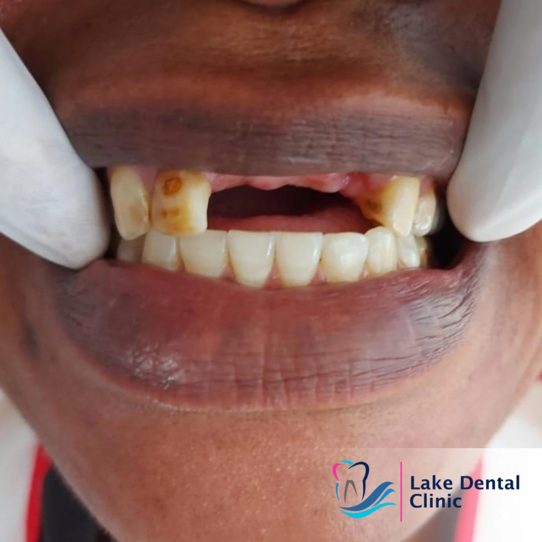 dentures, bridges and implants teeth replacement for missing teeth