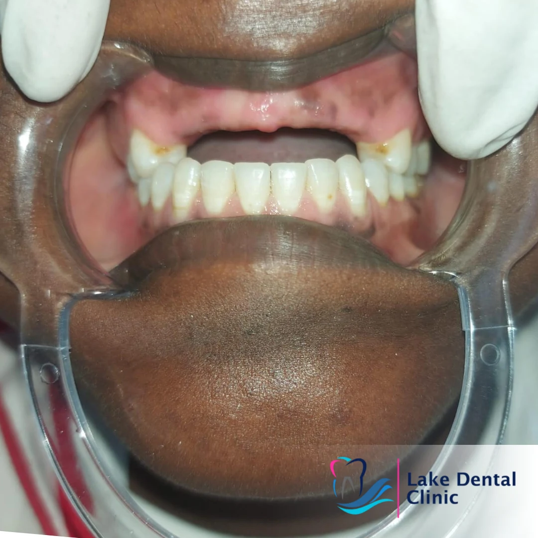 dentures, bridges and implants teeth replacement for missing teeth