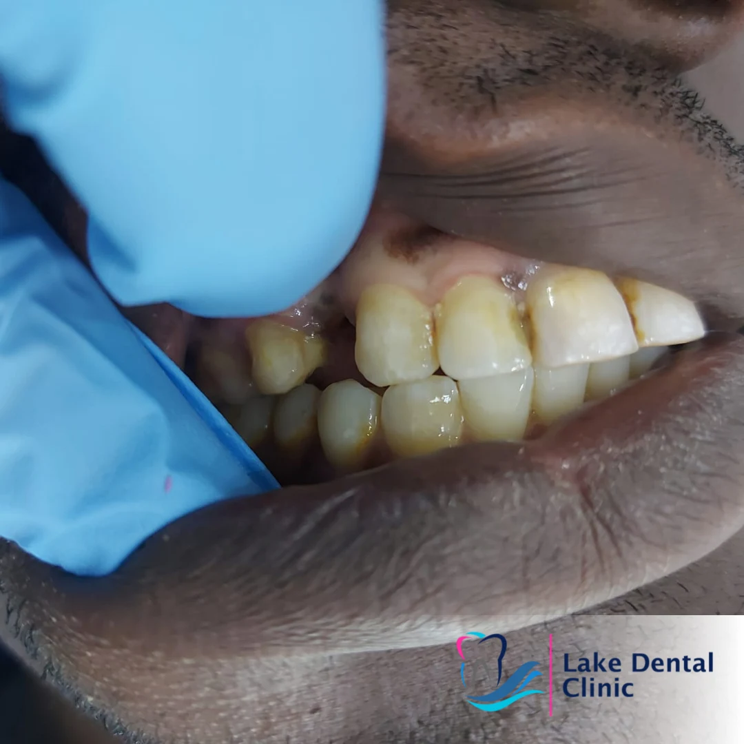 dental crowns and bridges permanent replacement for missing teeth