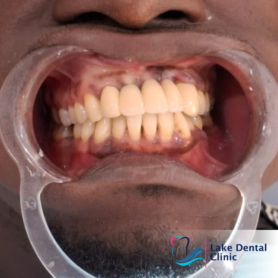 permanent teeth replacement with dental crowns and bridges