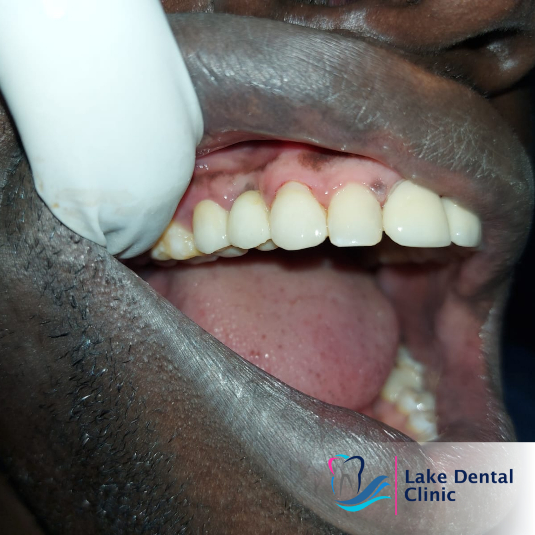 dental crowns and bridges permanent replacement for missing teeth