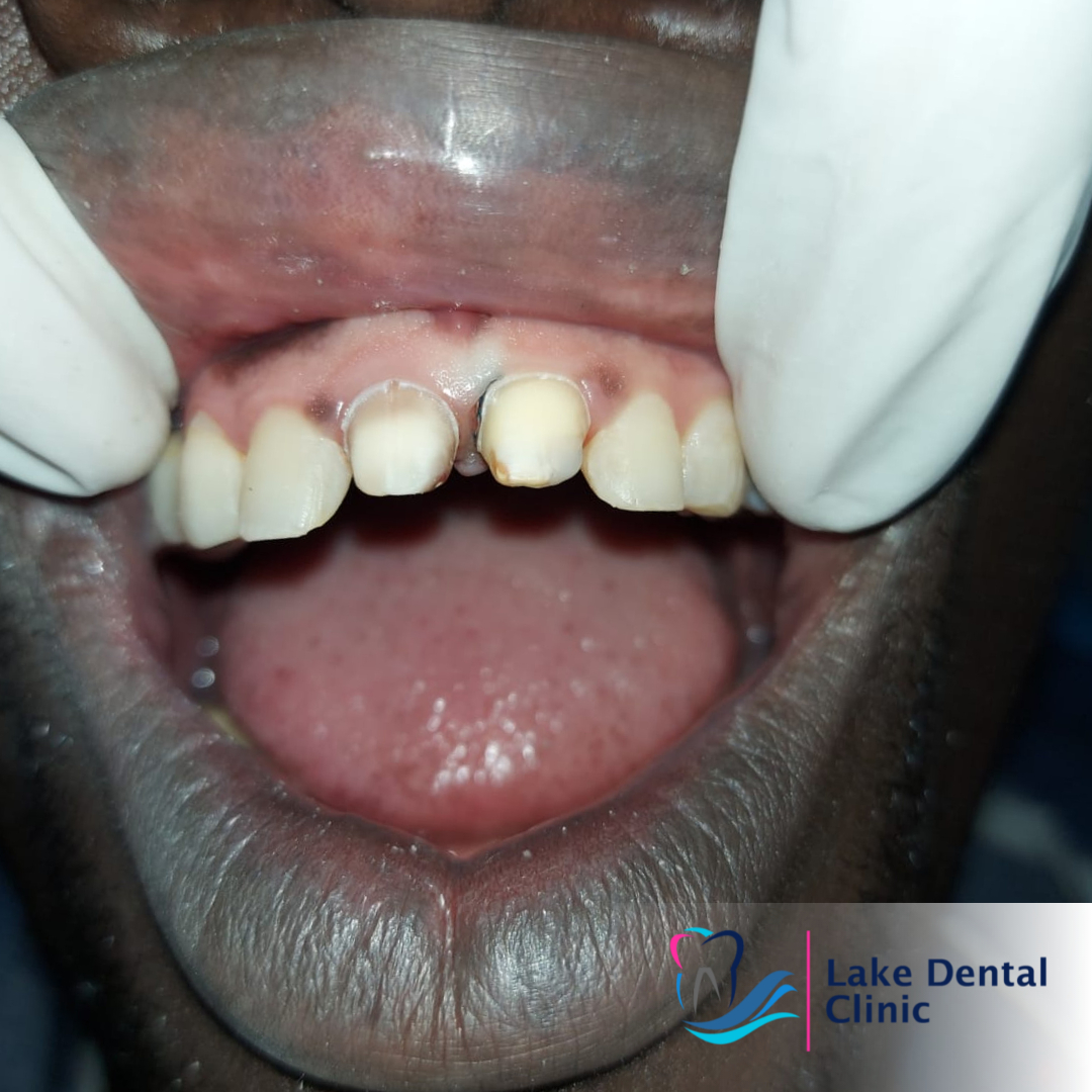 Dental crowns and bridges in Nairobi