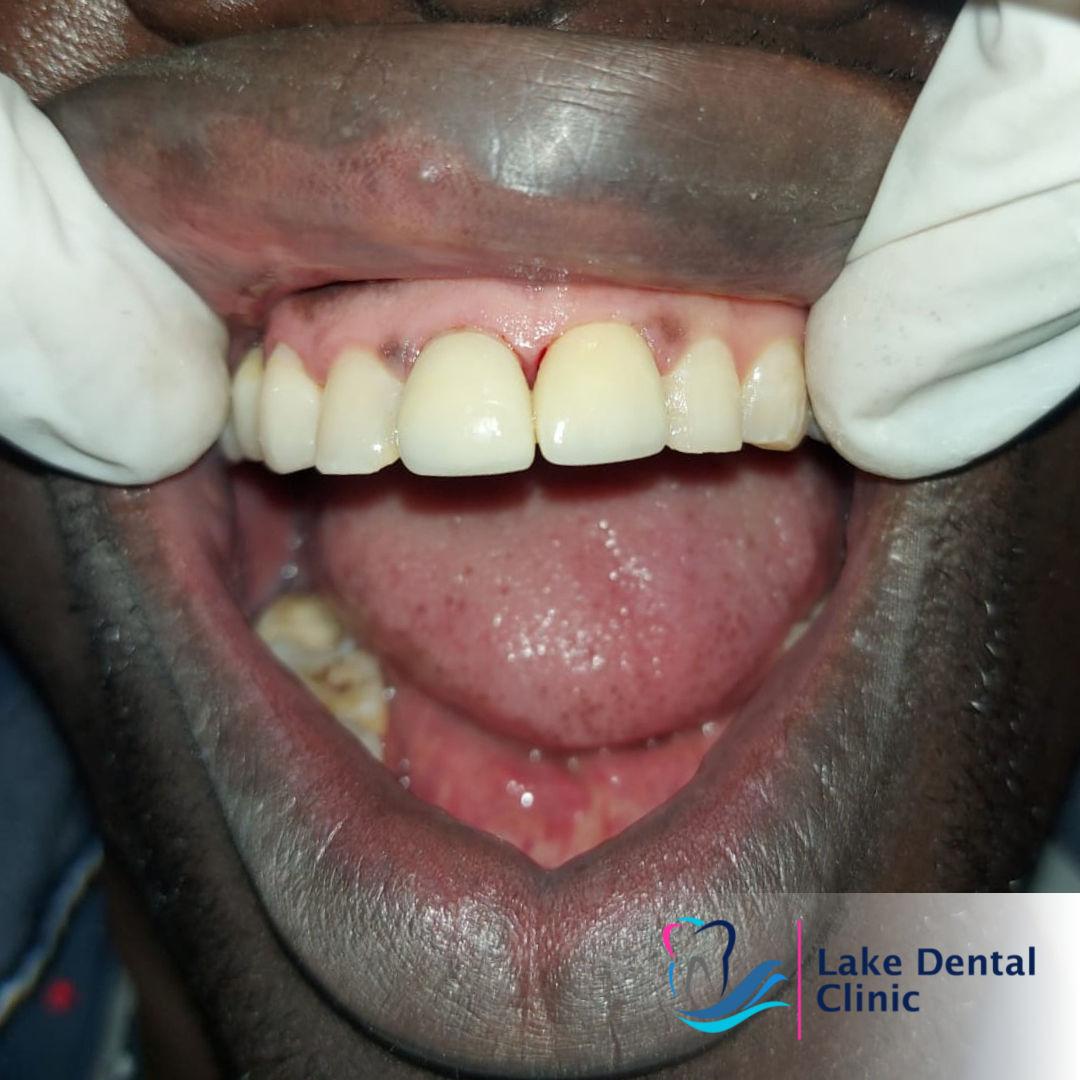 Dental crowns and bridges in Nairobi