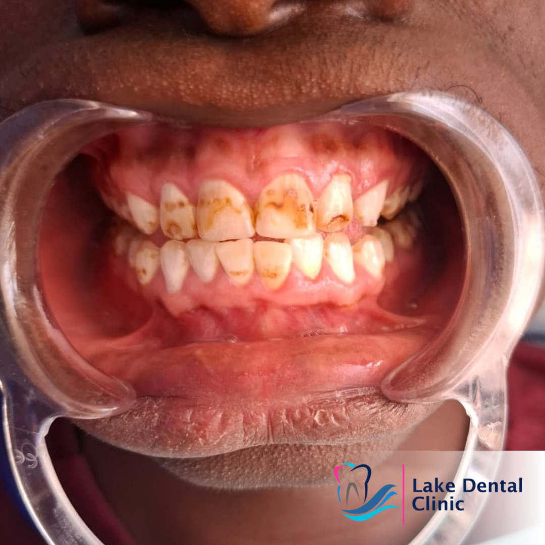 Dental masking treatment for dental fluorosis teeth whitening