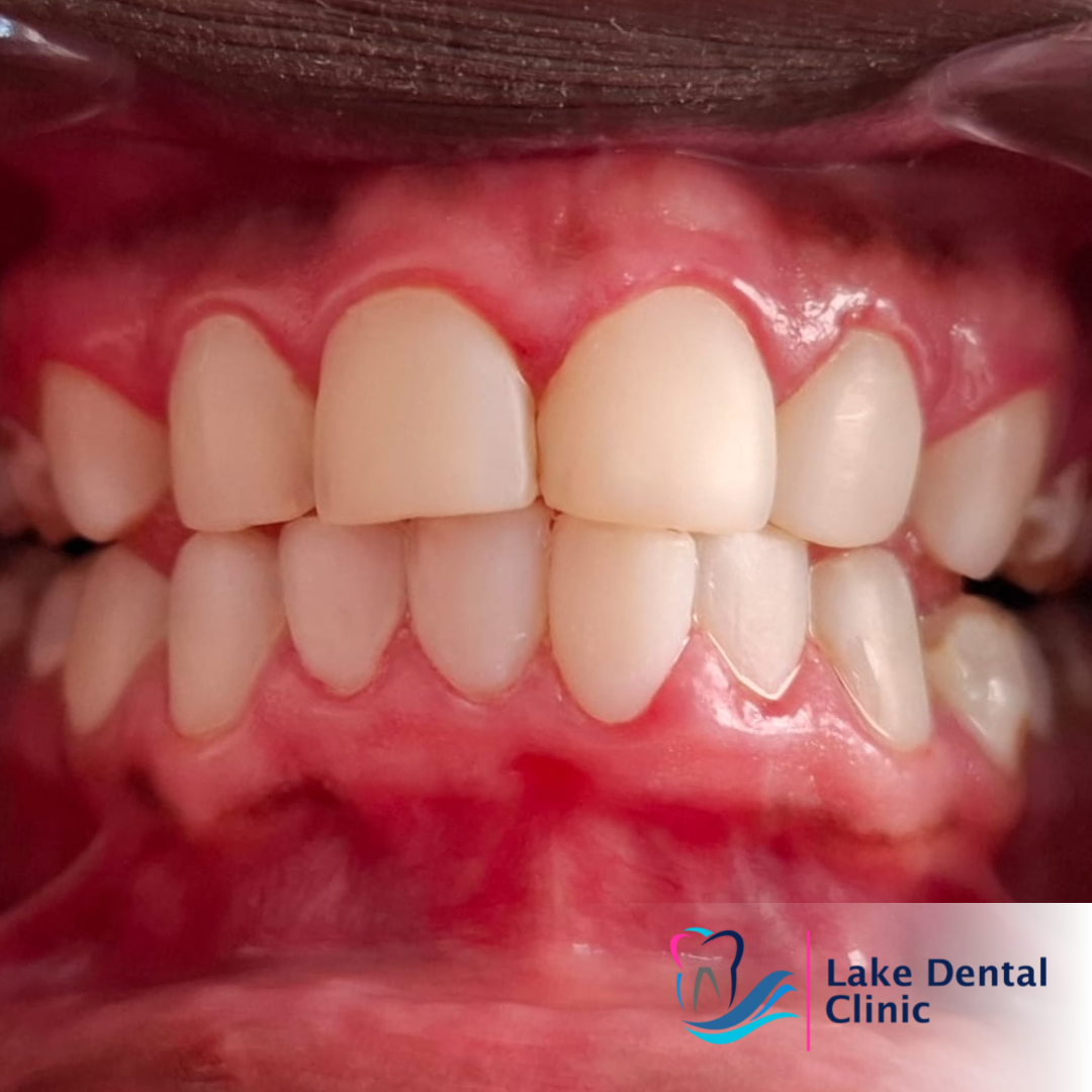 Dental masking treatment for dental fluorosis teeth whitening