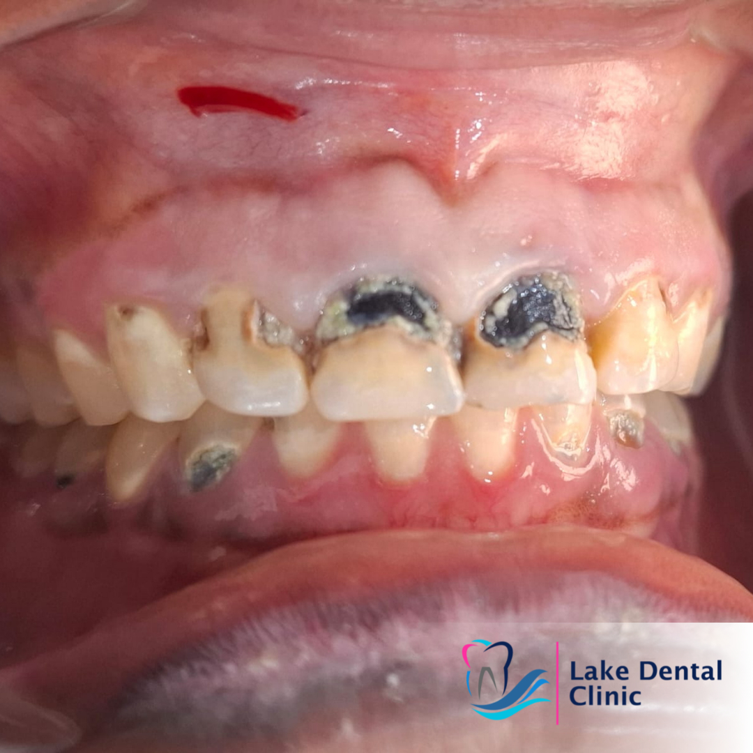 treatment for tooth decay in Nairobi and Kisumu