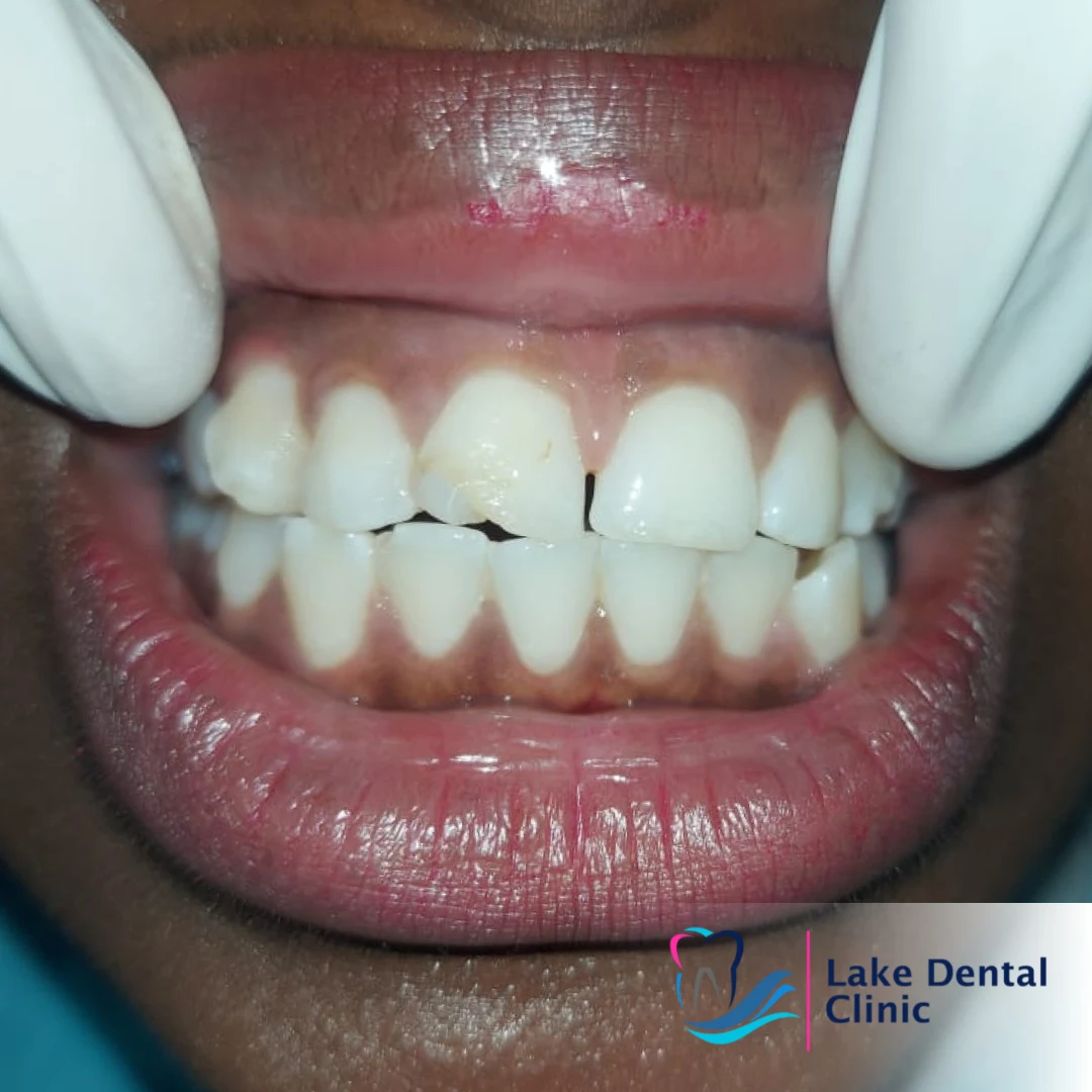 tooth filling for chipped and cracked teeth