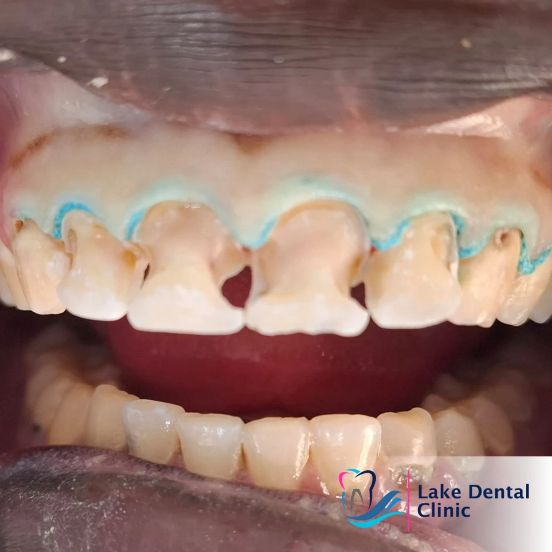 treatment for tooth decay in Nairobi and Kisumu