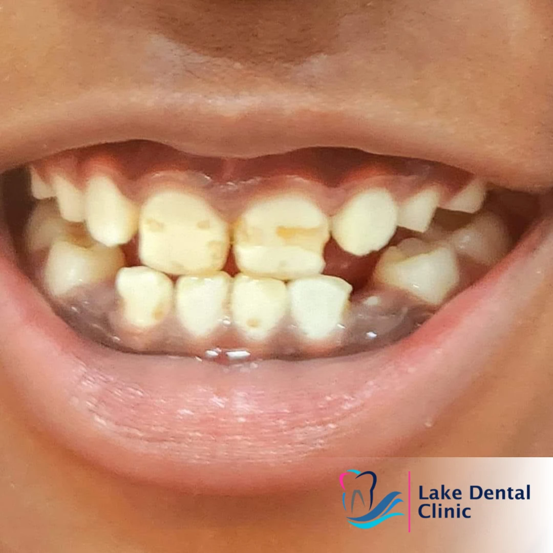 Dental masking treatment for dental fluorosis teeth whitening