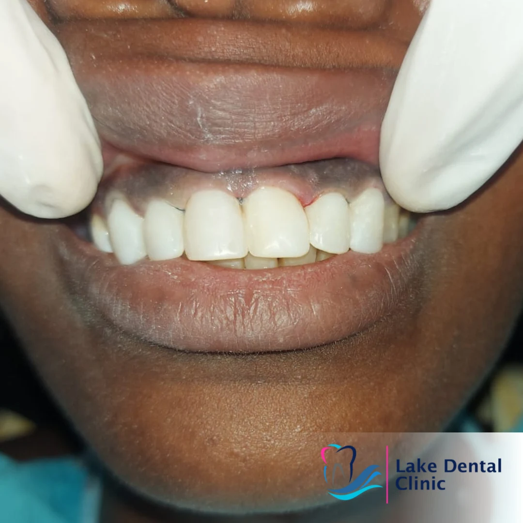 Dental masking treatment for dental fluorosis teeth whitening