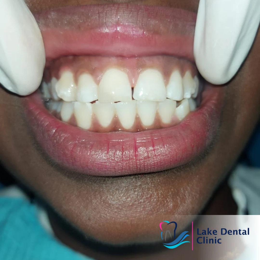 tooth filling for chipped and cracked teeth