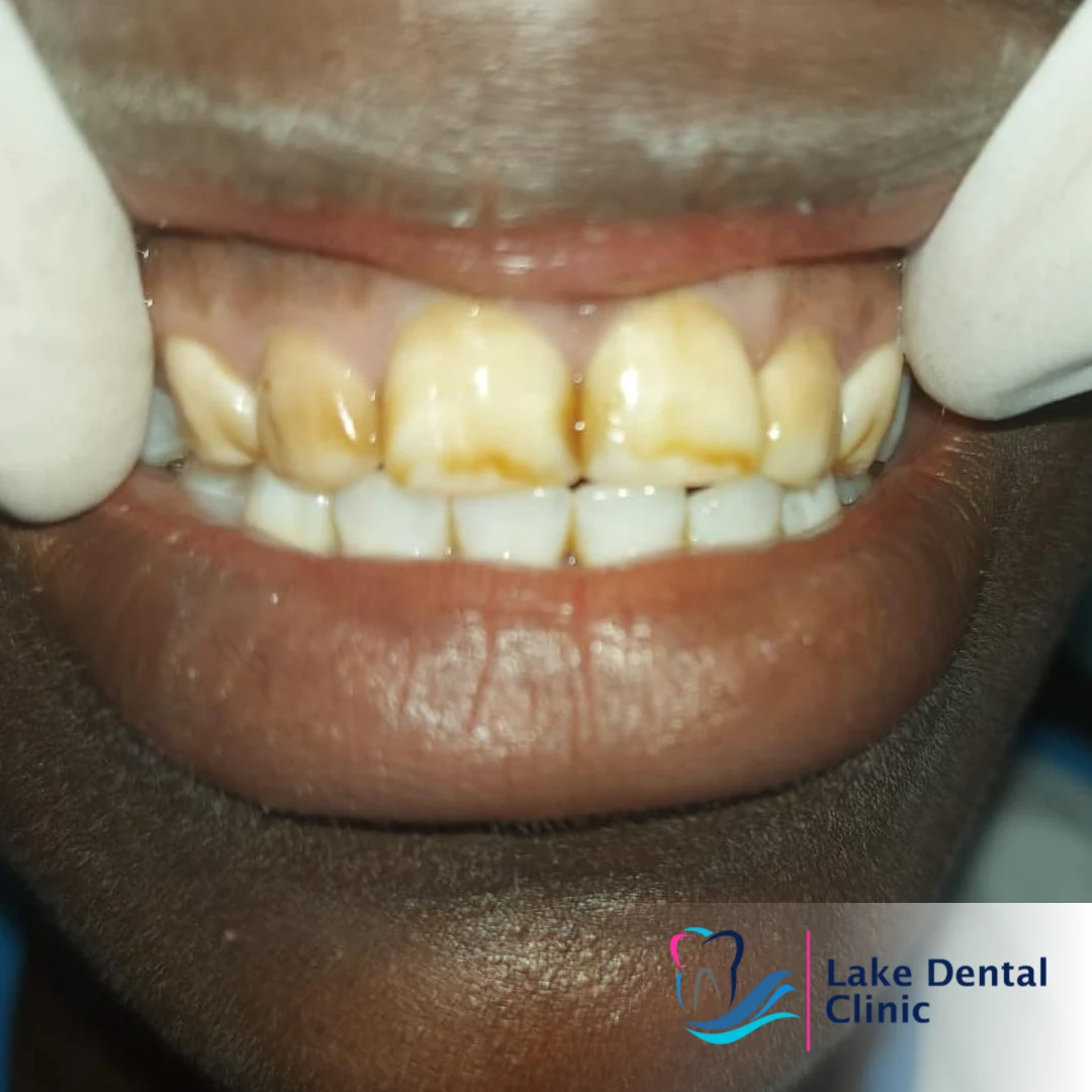 Dental masking treatment for dental fluorosis teeth whitening