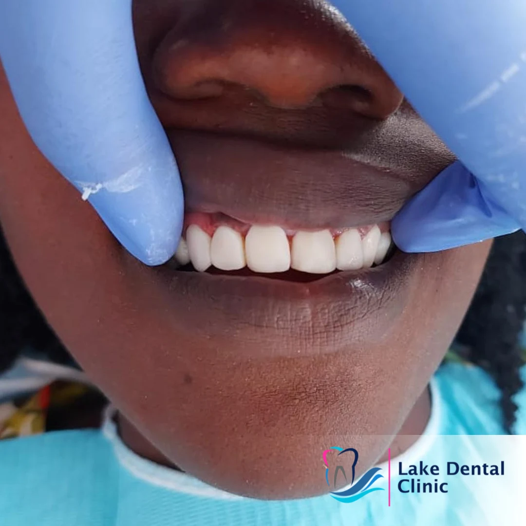 Dental masking treatment for dental fluorosis teeth whitening