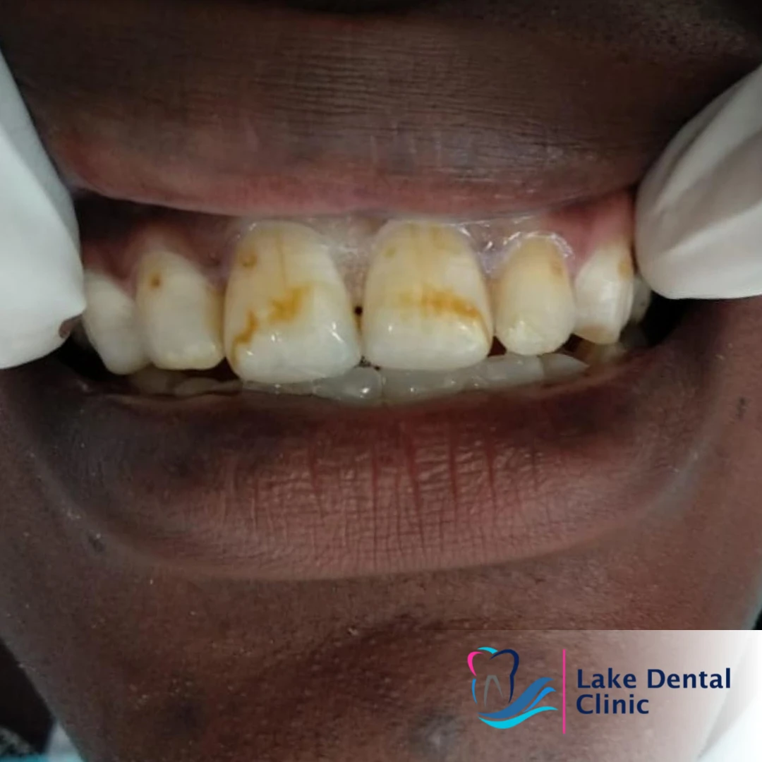 Dental masking treatment for dental fluorosis teeth whitening