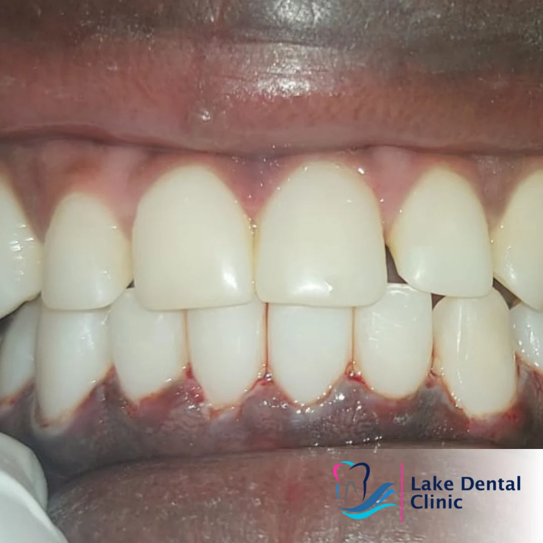 Dental masking treatment for dental fluorosis teeth whitening