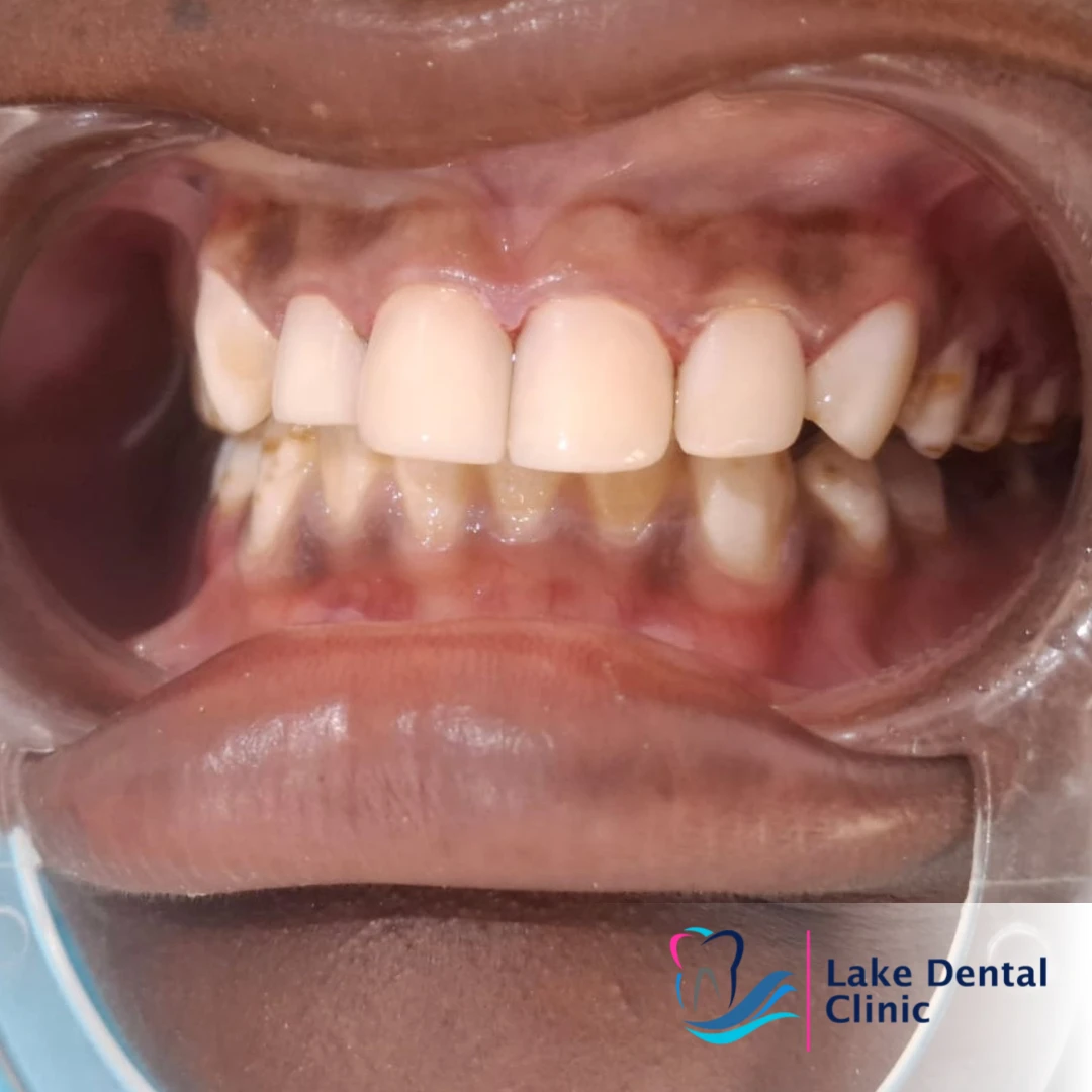 teeth whitening (dental masking) for dental fluorosis (brown teeth)