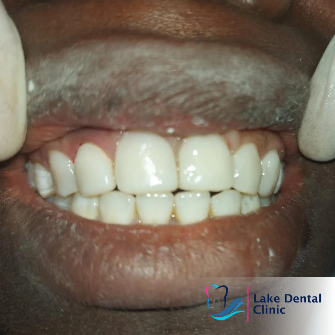 Dental masking treatment for dental fluorosis teeth whitening